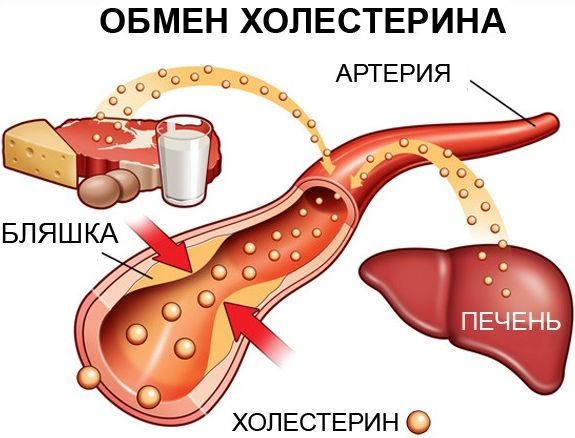 причины развития атеросклероза